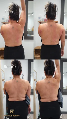 Range of motion before and after